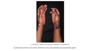 DERMATOLOGIE LES ECZEMAS [upl. by Maurita]