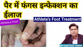 What is Fungal Foot Tinea Pedis Treatment  Athletes Foot [upl. by Reifel]