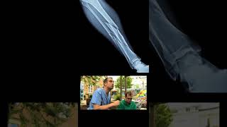 Broken Leg Symptoms and Causes  Diagnosis  Treatment  Prevention disease healthcare healthy [upl. by Dode]