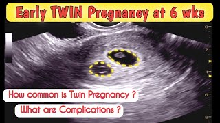 6wks Early TWIN Pregnancy  what are Complications of TWINS [upl. by Edwyna]