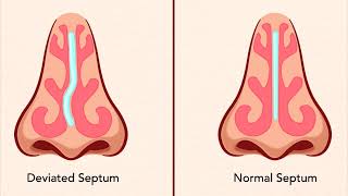 Heal a deviated nasal septum  POWERFUL SUBLIMINAL [upl. by Curzon]