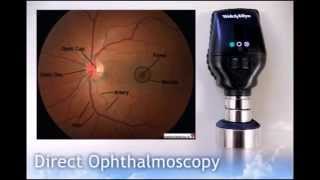 Direct Ophthalmoscopy [upl. by Summons]