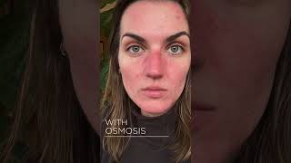 Osmosis Results  Blemish Prone Skin [upl. by Hourihan]