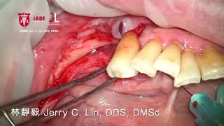 Vertical ridge augmentation with FDBA amp Tireinforced dPTFE membrane [upl. by Ilohcin]