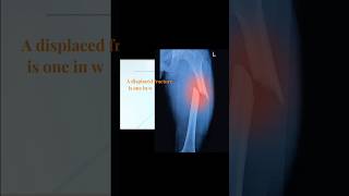 Bone fracture orthopedics bones [upl. by Biernat489]