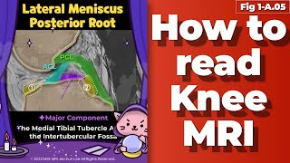 Fig 1A05 Anatomy of the Lateral Meniscus Posterior Root two components intertubercular area [upl. by Travers232]