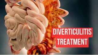 How To Treat Diverticulitis in 2024 [upl. by Mazel]