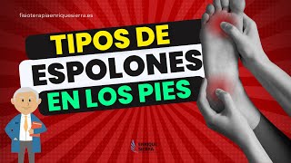 TIPOS DE ESPOLONES EN LOS PIES O EL TALÓN 👣 [upl. by Carlota]