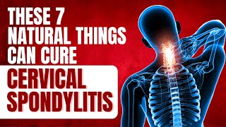 Neck Pain How to Cure Cervical Spondylitis Permanently at Home [upl. by Lynnet888]