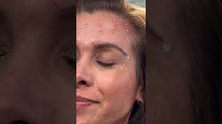 Botox lateral brow lift 25 units each side botox aesthetics aestheticdoctor [upl. by Verene587]