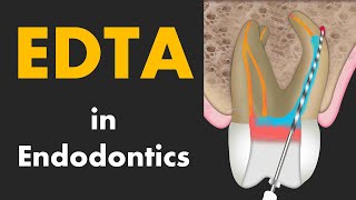 EDTA in Root Canal Treatment [upl. by Eardna305]