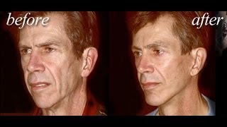 Dr Delgado discusses “The Art of the Modern and Natural Male Facelift [upl. by Lynch]