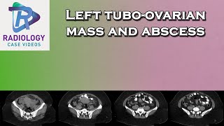 Left tuboovarian mass and abscess [upl. by Baskett]