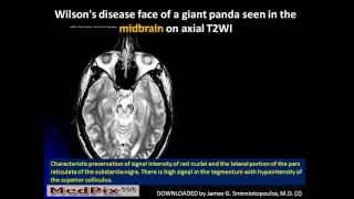 MedPix Week 666 Wilsons Disease from Kristin Kinsman Jeffrey Pollock MD Ryan Berecky MD [upl. by Ymaj414]