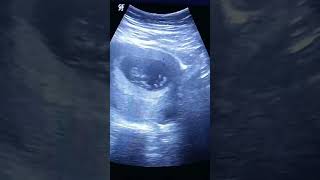 baby 11 weeks on ultrasound [upl. by Erle309]