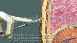 Thoracotomy  Normal Procedure [upl. by Drobman]