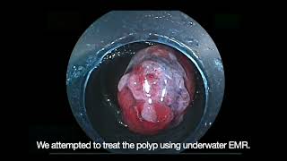 Gel immersion EMR of smallbowel inflammatory fibroid polyp using doubleballoon endoscopy [upl. by Necyla756]