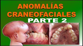 MALFORMACIONES CRANEOFACIALES O ANOMALIAS CONGENITAS DE DESARROLLO FACIAL PARTE 2 [upl. by Melodee]