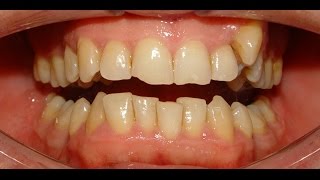 NonExtraction Therapy of Maxillary Constriction amp Severe Mandibular Crowding  Hazim 35yrs [upl. by Ettenrahs684]