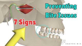 Preventing bite Issues 7 Critical Signs to assess before restoring a posterior tooth [upl. by Iasi]