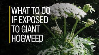 What to do if exposed to giant hogweed [upl. by Jerrilee]