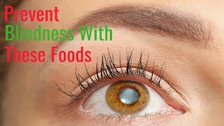 How to Prevent Cataracts Naturally With Foods [upl. by Bigford]