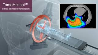 The TomoTherapy System vs Conventional Linacs [upl. by Nylaj442]