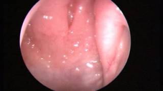 Video 1 Normal nasal endoscopy [upl. by Aneehc]