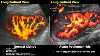 Kidney Ultrasound Normal Vs Pyelonephritis Imaging Findings  Acute Chronic amp Emphysematous Types [upl. by Nuhsed]