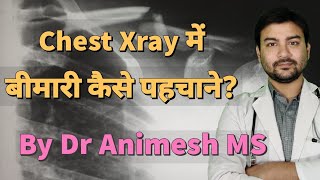 Chest Xray of Lung disease explained in hindi by DrAnimesh MS dranimesh surgeryonline pneumonia [upl. by Erna108]