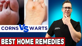 Plantar Warts vs Corns vs Calluses TOP 20 BEST Home Remedies [upl. by Adaval]