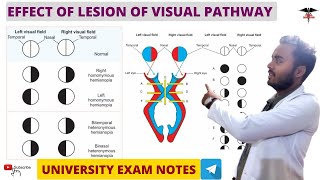 Effect Of Lesion On Visual Pathway  Special Sense Physiology [upl. by Kotto]