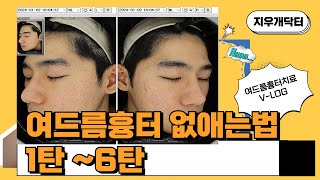 여드름흉터 없애는법 브이로그 1탄6탄 피부과 acne [upl. by Nahsor]