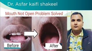 Mouth not open chewing Gutkha best medicine  osmf fibrosis treatment [upl. by Matilde866]