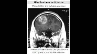 Glioblastoma Multiforme grade IV astrocytoma  Most Common Primary Brain Tumor [upl. by Mchugh]