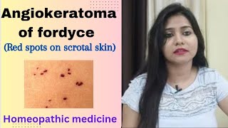 Angiokeratoma of fordyce  red bumps on scrotal skin  symptomscause amp Homeopathic medicine hindi [upl. by Hadihsar]