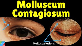 Molluscum Contagiosum Water Warts – Symptoms Causes Diagnosis Treatment amp Complications [upl. by Nangem]