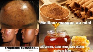 Masque au miel et cannelle contre lacné boutons eczéma cicatrice pores dilatés tâches [upl. by Hymen]