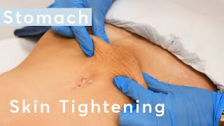 Skin Tightening Stomach  HIFU Ultraformer III Treatment [upl. by Glenna]