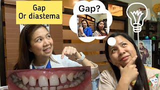 Causes and Solutions on Gaps Between Teeth Mga Dahilan at Solusyon sa mga PagitanSpaces ng Ipin [upl. by Atthia]