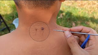 PLUCKING INGROWN BACK HAIR REMOVAL for Mr trewquonglahnvd asmr [upl. by Dorise]