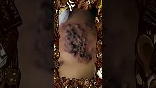 Blackheads Removal  Acne Treatment and Very Satisfying Satisfying Pimple pop blackheads [upl. by Sunshine]