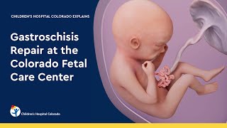 Gastroschisis Repair at the Colorado Fetal Care Center [upl. by Gokey]