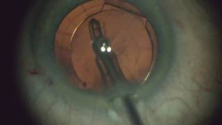 Intraocular Lenses  Inserting a Trulign toric lens [upl. by Llemrej232]