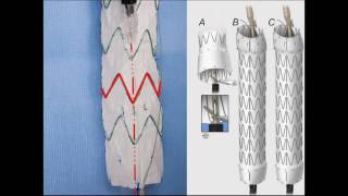 Dr Gustavo Oderich  Physician Modified Fenestrated Endografts Technical Aspects and Outcomes [upl. by Hitoshi]