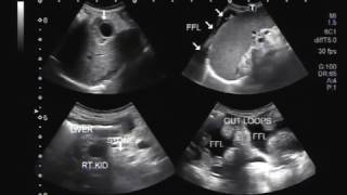 Ultrasound Video showing findings of a typical patient suffering from Hepatic Parenchymal disease [upl. by Boudreaux]