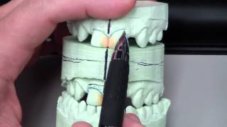 Diastema Closure  Dr Queso Discussion [upl. by Atterual671]