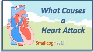 What Causes a Heart Attack [upl. by Nomzzaj246]