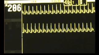 SVT  Supraventricular Tachycardia  ACLS Rhythm Recognition and Guidelines [upl. by Tenney]