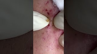 Big Cystic Acne Blackheads Extraction Blackheads amp Milia Whiteheads Removal Pimple Popping shorts [upl. by Leuamme]